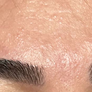 Mersin Marina Gratis Beauty Merkezi İşlem Sonrası Reaksiyonlar