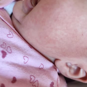 Mustela Ürün Yüzünden Bebeğimin Yüzü Kızardı!