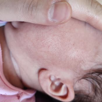 Mustela Ürün Yüzünden Bebeğimin Yüzü Kızardı!