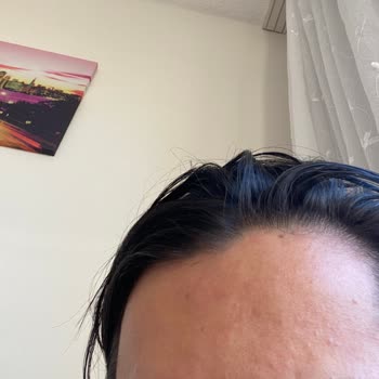 Yves Rocher Geçmeyen Saç Derisi Kaşıntısı Ve Yüzümde Oluşan Kabarcıklar