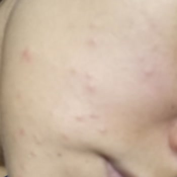 Rise & Shine Sabun Yüzümde Sivilce Çıkardı