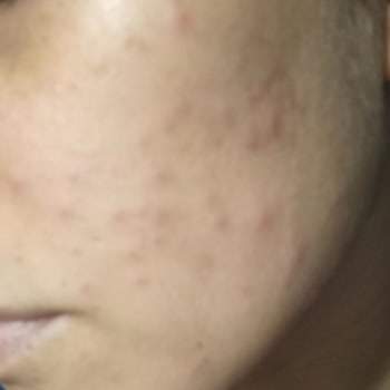 Rise & Shine Sabun Yüzümde Sivilce Çıkardı