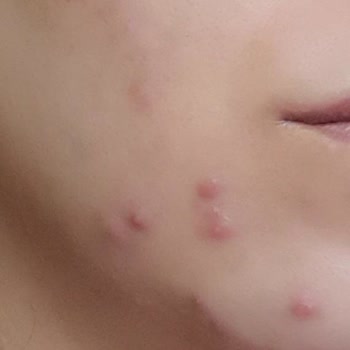 Duaderm Yüzümde Sivilce Yaptı