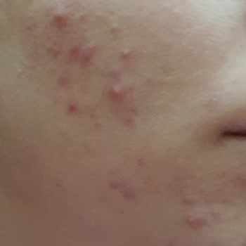 Duaderm Yüzümde Sivilce Yaptı