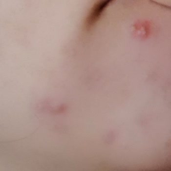 Duaderm Yüzümde Sivilce Yaptı