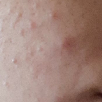 Duaderm Yüzümde Sivilce Yaptı