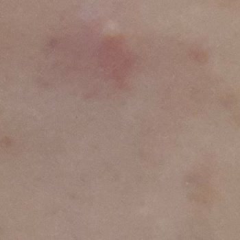 Duaderm Yüzümde Sivilce Yaptı