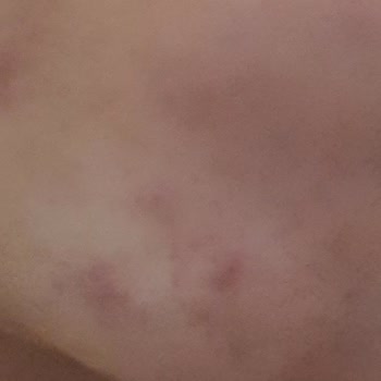 Duaderm Yüzümde Sivilce Yaptı