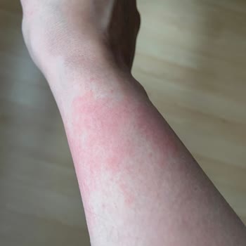 Estetic Derm Nişantaşı Lazer Epilasyon Deneyimim