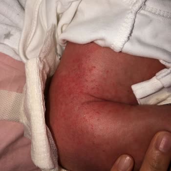 Mustela Bebek Şampuanı ve Yağı Döküntü Yaptı