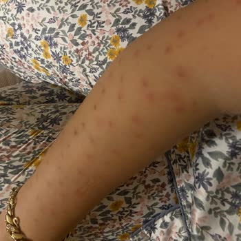 Dermo Güzellik Salonu Lazer Yanığı ve İlgisizlik