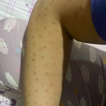 Dermo Güzellik Salonu Lazer Yanığı ve İlgisizlik