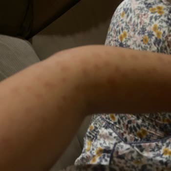 Dermo Güzellik Salonu Lazer Yanığı ve İlgisizlik