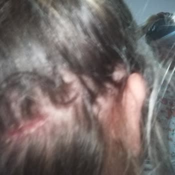 OGX Biotin Collagen Şampuanın Saç Derimde Oluşturduğu Yaralar.