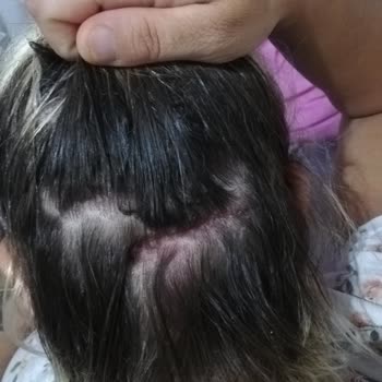 OGX Biotin Collagen Şampuanın Saç Derimde Oluşturduğu Yaralar.