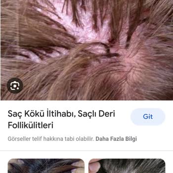 OGX Biotin Collagen Şampuanın Saç Derimde Oluşturduğu Yaralar.