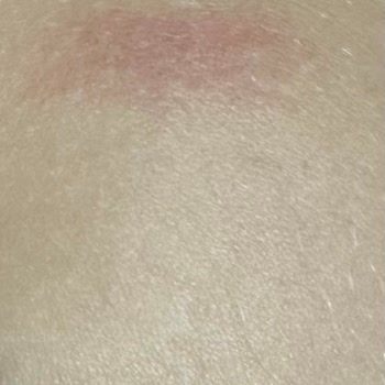 The Ritual Of Beauty Lazer İşlemi Şikayeti