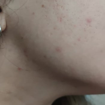 Yves Rocher Ürün Cildimde Sivilcelenme Yaptı