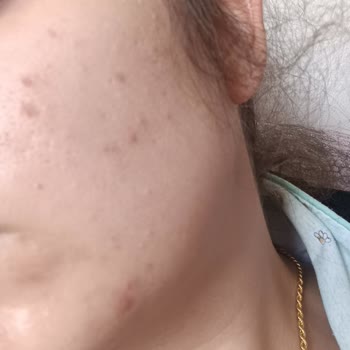 Dr. Öz Klinik Ürünleri Yüzde Kapalı Komedon Yaptı