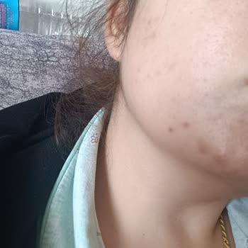 Dr. Öz Klinik Ürünleri Yüzde Kapalı Komedon Yaptı