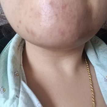 Dr. Öz Klinik Ürünleri Yüzde Kapalı Komedon Yaptı