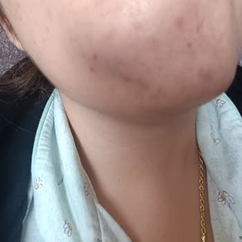 Dr. Öz Klinik Ürünleri Yüzde Kapalı Komedon Yaptı