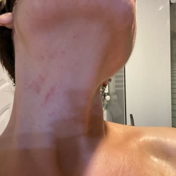 Rossmann Bakuchiol Serum Alerjisi