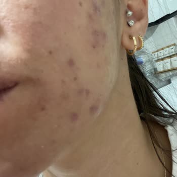 La Roche - Posay Yanma Ve Kızarıklık