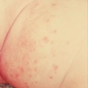 Sleepy Bez Alerji Yaptı