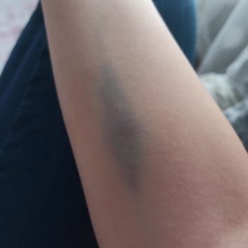 Hacettepe Üniversitesi Hastanesi Hacettepe Acilden Şikayetçiyim
