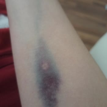 Hacettepe Üniversitesi Hastanesi Hacettepe Acilden Şikayetçiyim