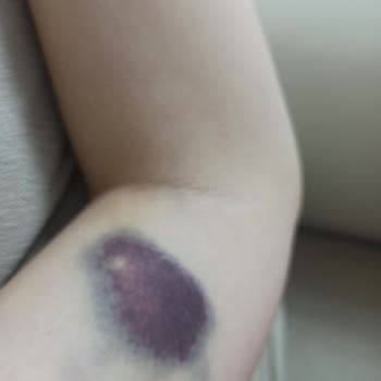 Hacettepe Üniversitesi Hastanesi Hacettepe Acilden Şikayetçiyim