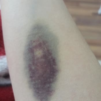 Hacettepe Üniversitesi Hastanesi Hacettepe Acilden Şikayetçiyim