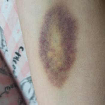 Hacettepe Üniversitesi Hastanesi Hacettepe Acilden Şikayetçiyim