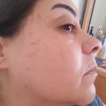 Vogue Lux Güzellik Merkezi Yüzüm Yandı