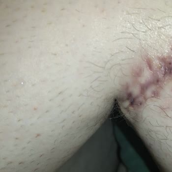 Elmas Lazer Lazer Yanığı Sonrası