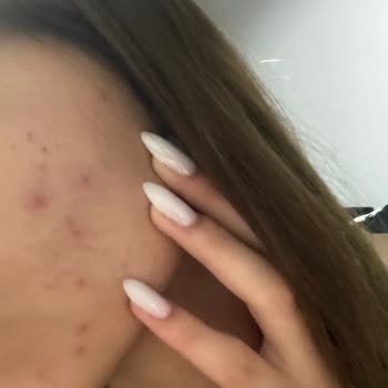 The Purest Solutions The Purest Ürünleri Şikayeti