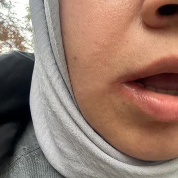 Hacettepe Üniversitesi Hastanesi Hacettepe Diş Fakültesi Hastanesi Stj Öğrenci Ağzımın Kenarını Yırttı!
