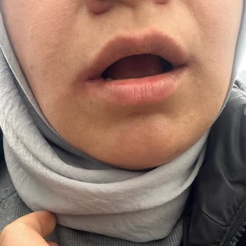 Hacettepe Üniversitesi Hastanesi Hacettepe Diş Fakültesi Hastanesi Stj Öğrenci Ağzımın Kenarını Yırttı!