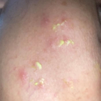 Rise & Shine Dilan Polat Sabunları Yüzünde Kırmızı Kabarcıklar Oluşturdu