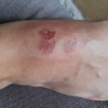 Fizmer Polikliniği 2. Derece Yanık - Epilasyon