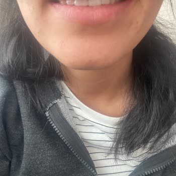 Op. Dr. Furkan Şengöz Burnumu Mahvetti