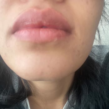 Op. Dr. Furkan Şengöz Burnumu Mahvetti