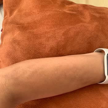 Renew Beauty Lazerde Kollarım Yandı