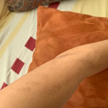 Renew Beauty Lazerde Kollarım Yandı