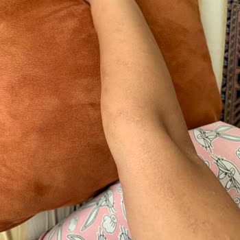 Renew Beauty Lazerde Kollarım Yandı