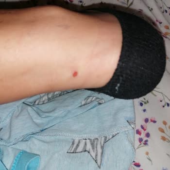 Skechers Ayakkabının Rahatsızlığı Firma Mağdur Etti