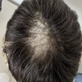 Oluşum Protez 'de Saç Hizmetinden Memnun Kalmadım