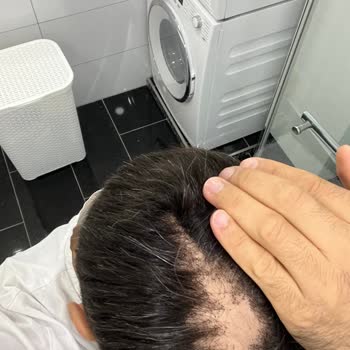 Oluşum Protez 'de Saç Hizmetinden Memnun Kalmadım