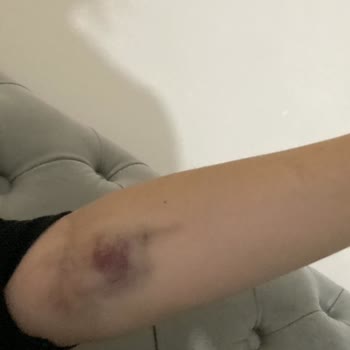 Ankara Bilkent Şehir Hastanesi Kanımı Alan Hemşire Kolumdaki Damarı Patlattı